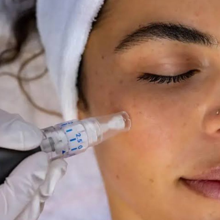 microneedling