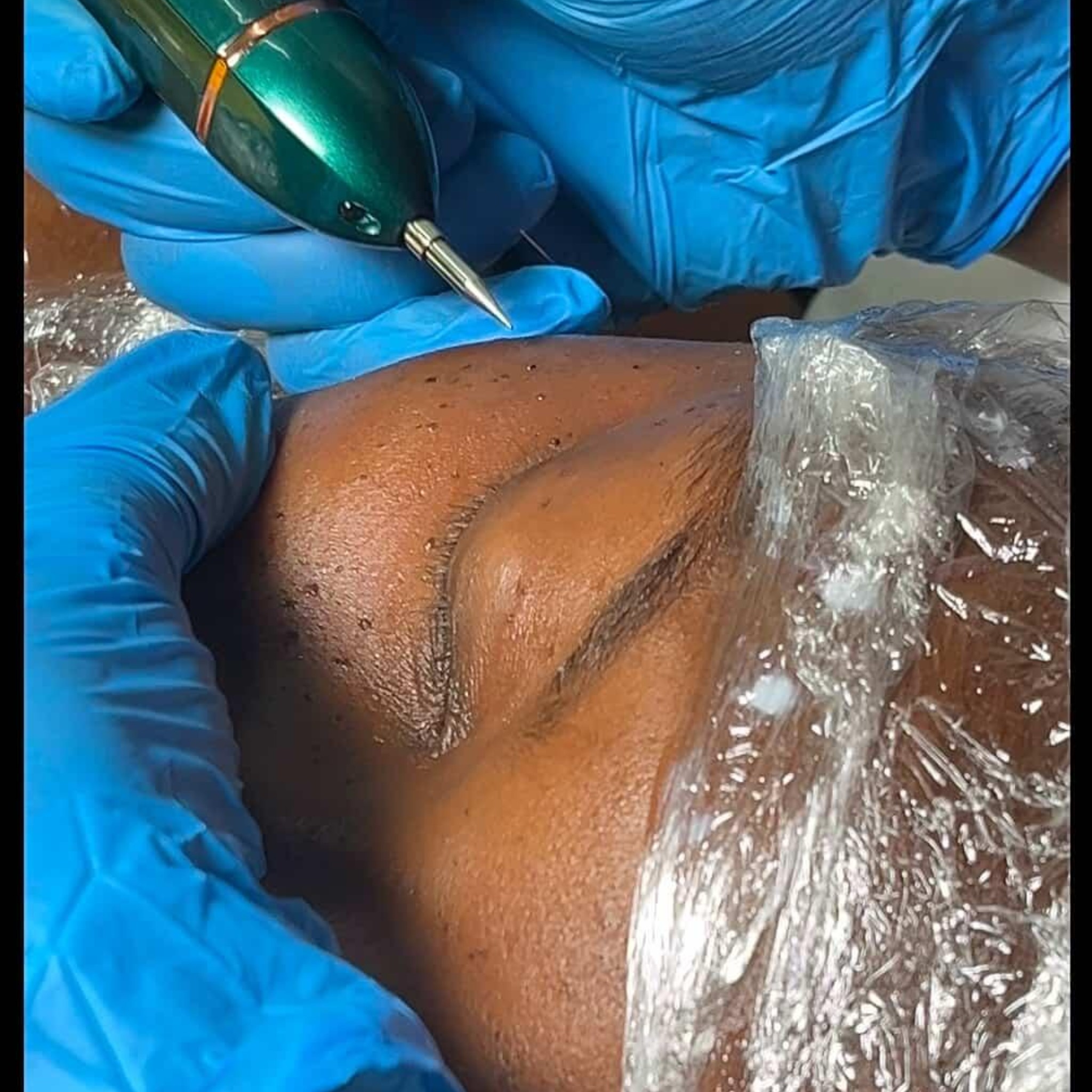 skin tag removal servoces